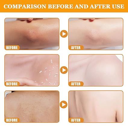 Orange Exfoliating Gel Removal